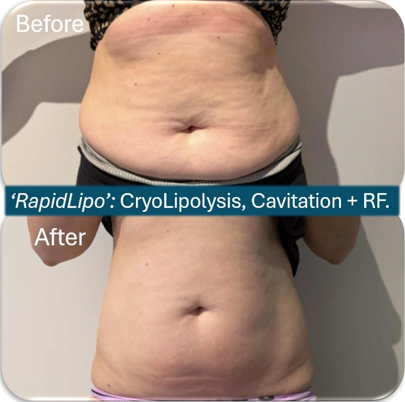 Before and after photographs of a client’s abdomen, captioned “RapidLipo: CryoLipolysis, Cavitation + RF”.